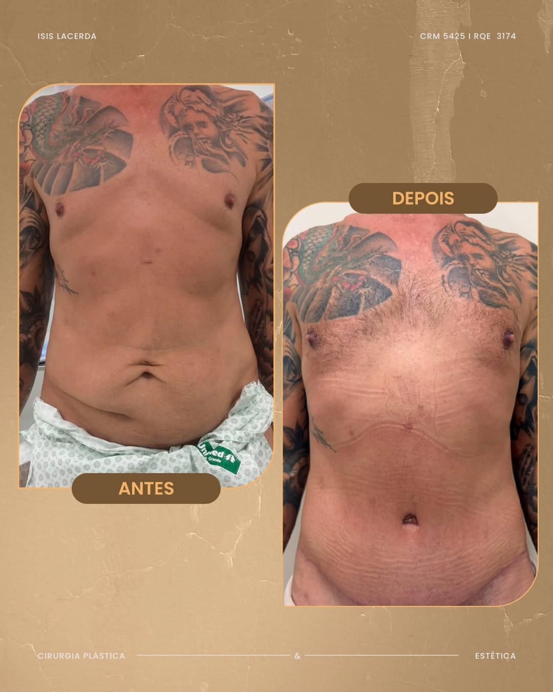 Antes e depois de pós-operatório de abdominoplastia masculina