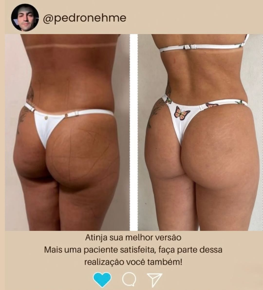 Antes e depois de contorno corporal feminino