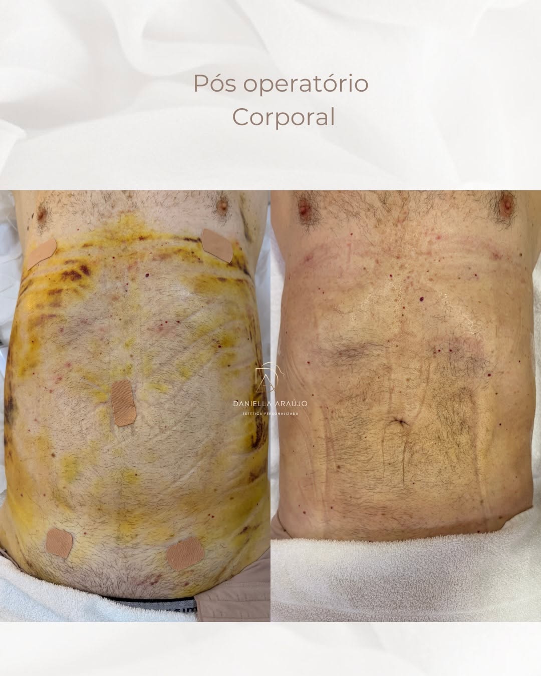 Antes e depois de pós-operatório corporal